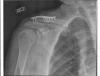 plate-clavicle-sm.jpg